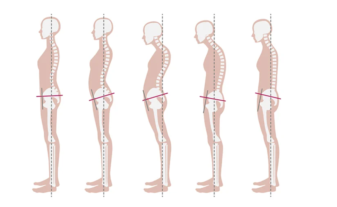 Aj zlé držanie tela môže spôsobiť bolesť chrbta. Ako stáť správne?